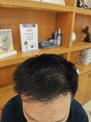 -大麦微针植发全国连锁