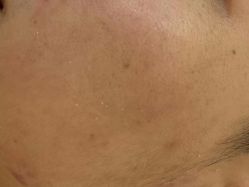 -美肤盾祛痘·问题肌头疗管理中心