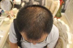 -大麦微针植发丨全国连锁