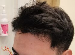 -大麦微针植发丨全国连锁