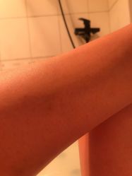 体验后-东剑医学美容·注射美学中心