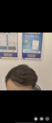 -大麦微针植发全国连锁