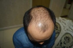 -大麦微针植发丨全国连锁