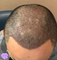 -大麦微针植发丨全国连锁