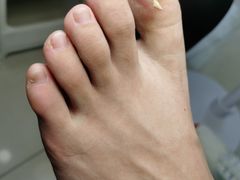 -世龙世家甲沟炎·灰指甲·嵌甲矫正·修脚(武侯区双楠店)