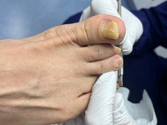-Andrew指甲专科灰指甲·甲沟炎矫正·3D步态矫形鞋垫定制(上海法华镇路旗舰店)