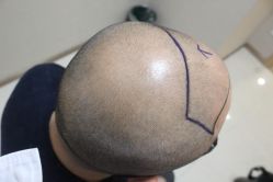 点击看大图 -大麦微针植发丨全国连锁