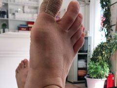 -世龙世家灰指甲鸡眼脚气甲沟炎跖疣护理(通州店)