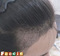 -大麦微针植发丨全国连锁