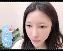 体验后-大麦微针植发全国连锁