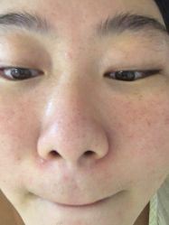-成都苗方清颜专业祛痘