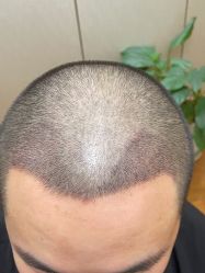 -大麦微针植发全国连锁