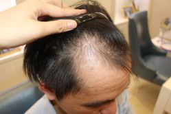 -大麦微针植发丨全国连锁