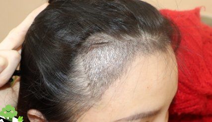 -大麦微针植发丨全国连锁