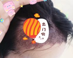 -大麦微针植发全国连锁