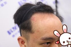 点击看大图 -大麦微针植发丨全国连锁