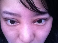 第三天-上海华安整形外科门诊部