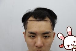 -大麦微针植发丨全国连锁