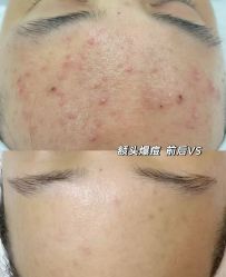 -瑶芳清颜草本祛痘