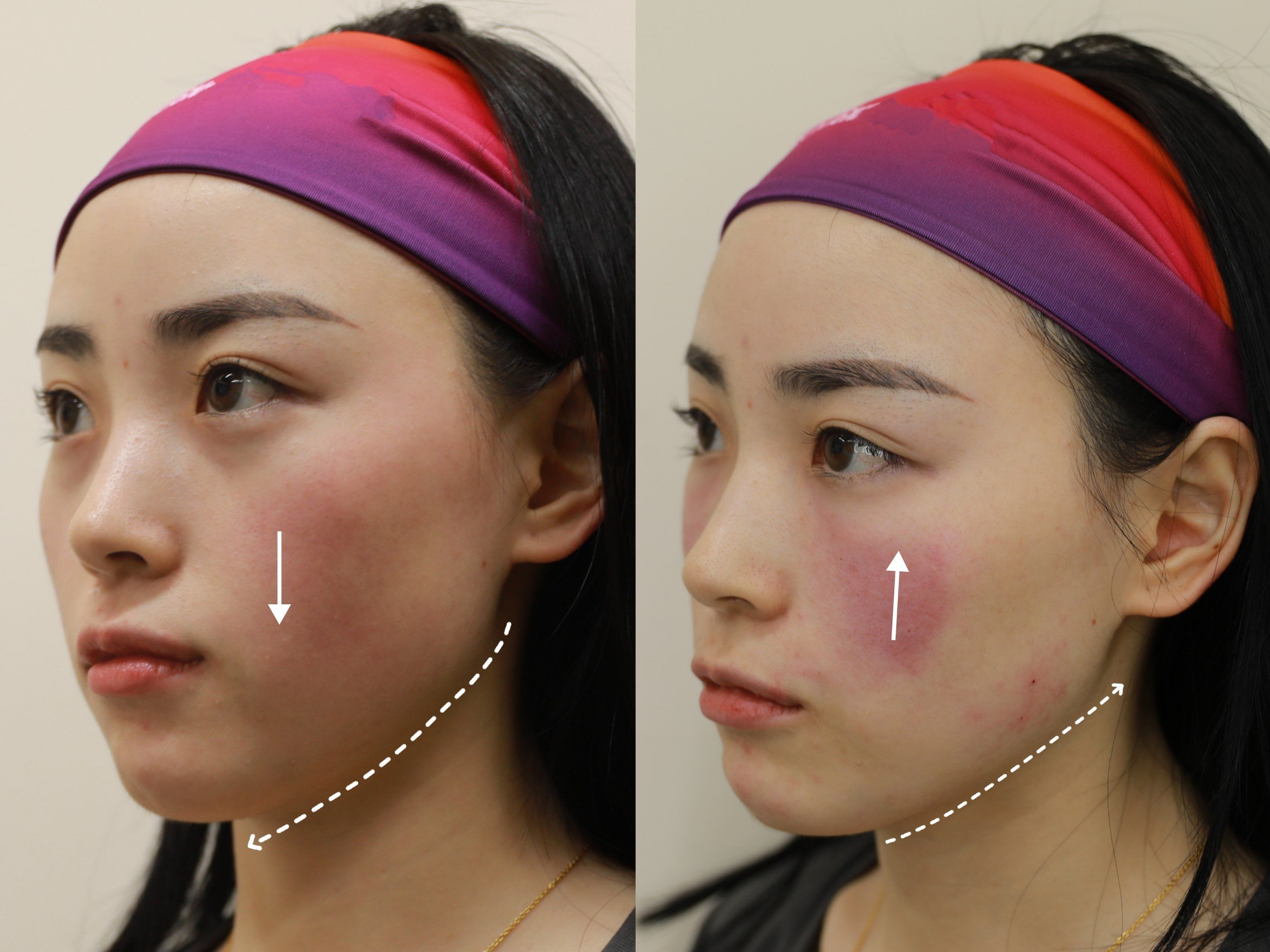 打了玻尿酸后,我敢拍侧面了!