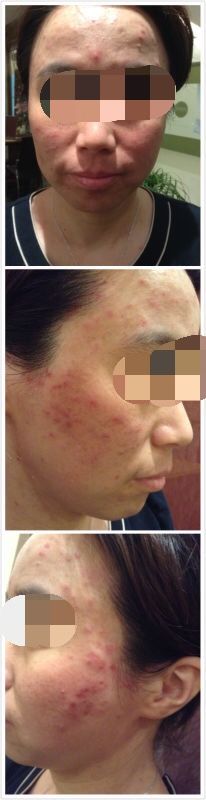 -皇族养心堂·净痘·修敏·御颜