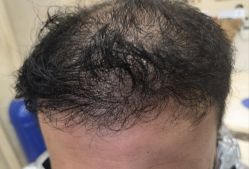 -碧莲盛·不剃发植发