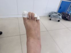 -德哥灰指甲脚气甲沟炎跖疣护理
