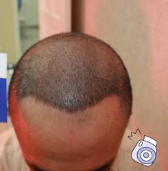 -大麦微针植发丨全国连锁