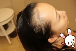 -大麦微针植发丨全国连锁