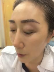 -大麦微针植发丨全国连锁