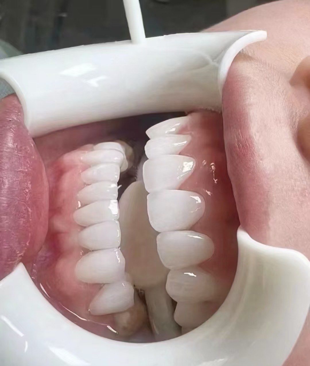 牙齿修复超简单