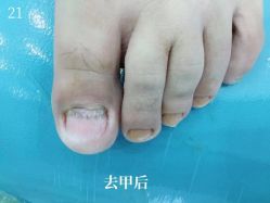 -德哥灰指甲脚气甲沟炎跖疣护理