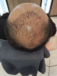 点击看大图 -大麦微针植发丨全国连锁