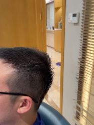 -大麦微针植发丨全国连锁