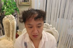 点击看大图 -大麦微针植发丨全国连锁