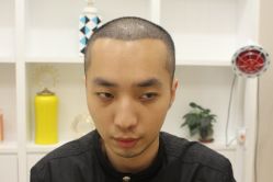 -大麦微针植发丨全国连锁