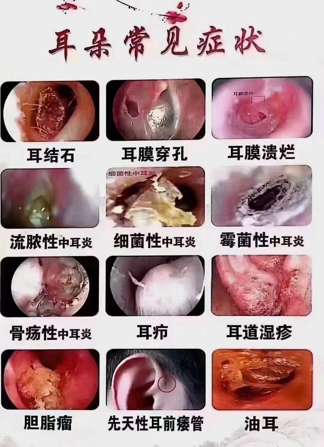 宝宝外耳道湿疹图片