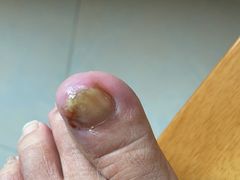 -祖传修脚甲沟炎灰指甲鸡眼