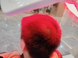 -碧莲盛·不剃发植发
