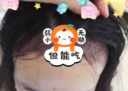 -大麦微针植发全国连锁