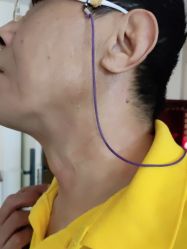 -美丽人生祛斑扁平疣汗管瘤中心