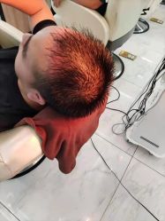 -大麦微针植发丨全国连锁