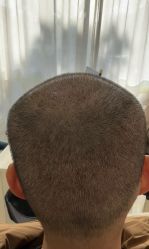 -大麦微针植发丨全国连锁