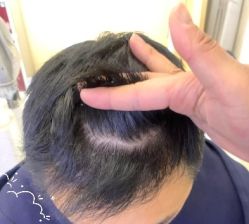 -大麦微针植发丨全国连锁