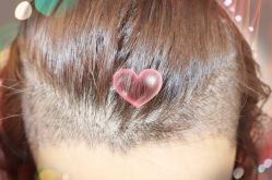 -大麦微针植发全国连锁