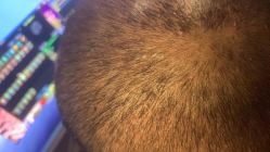 -大麦微针植发丨全国连锁