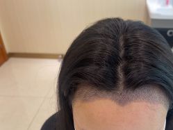 点击看大图 -碧莲盛·不剃发植发