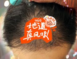 -大麦微针植发全国连锁