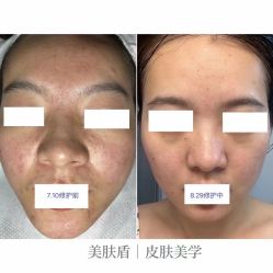 -美肤盾祛痘·问题肌头疗管理中心