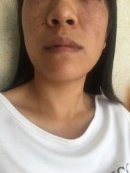 -痣清宫祛斑祛痣连锁店